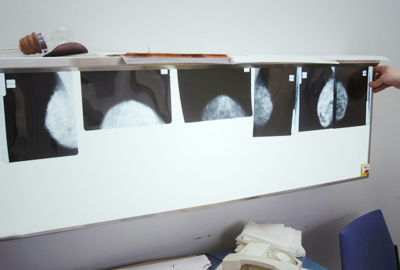 mammography